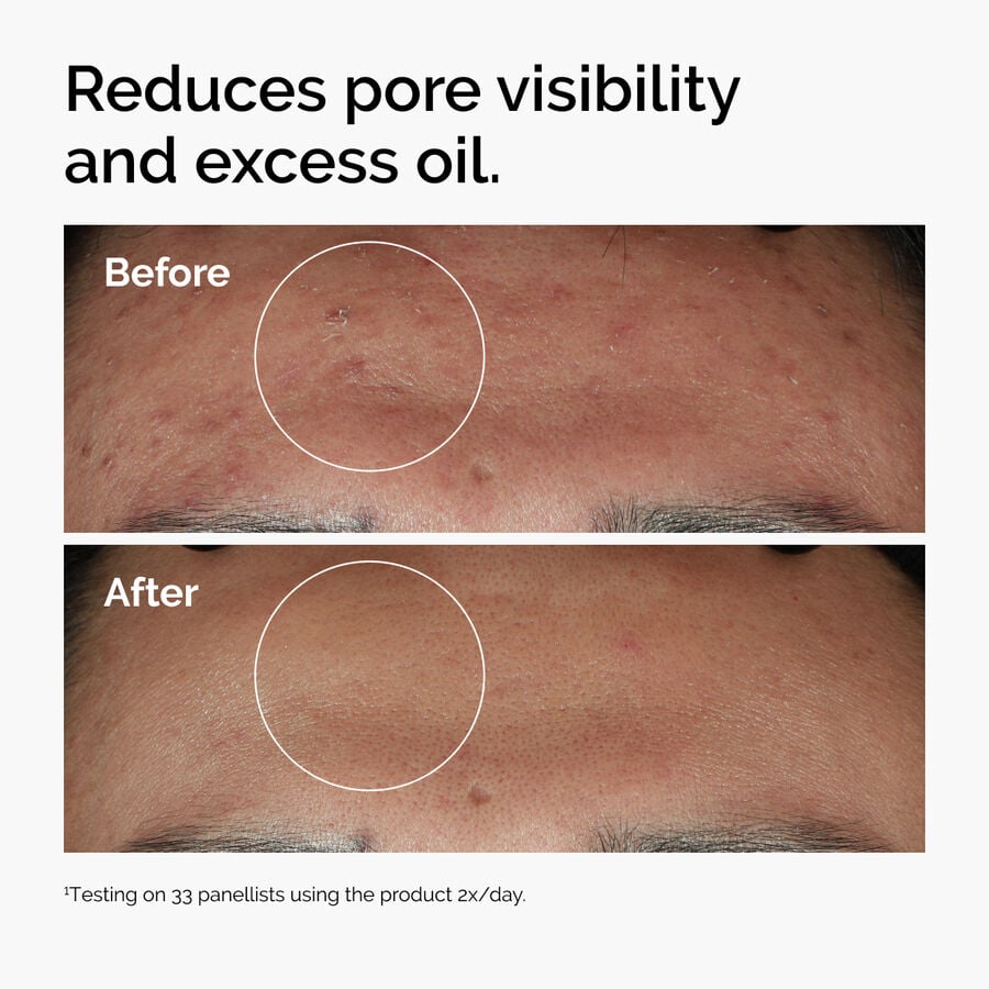 niacinamide-10-zinc-1-f1 ord-niacinamide-zinc-blemish-serum-before-after-pores.jpg
