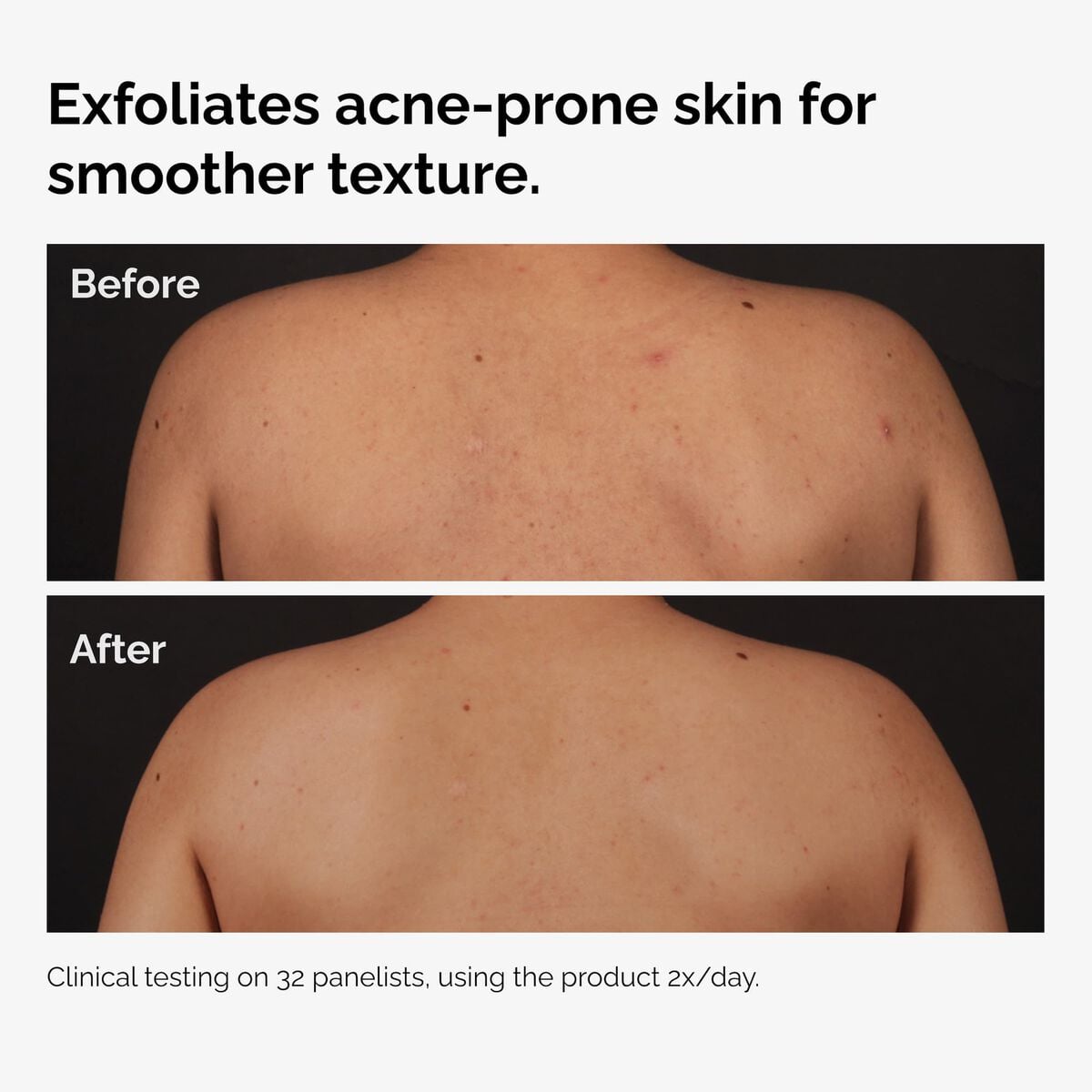 salicylic-acid-0-5-body-serum-k3 ord-salicylic-acid-body-serum-before-after-graphic-NA.jpg