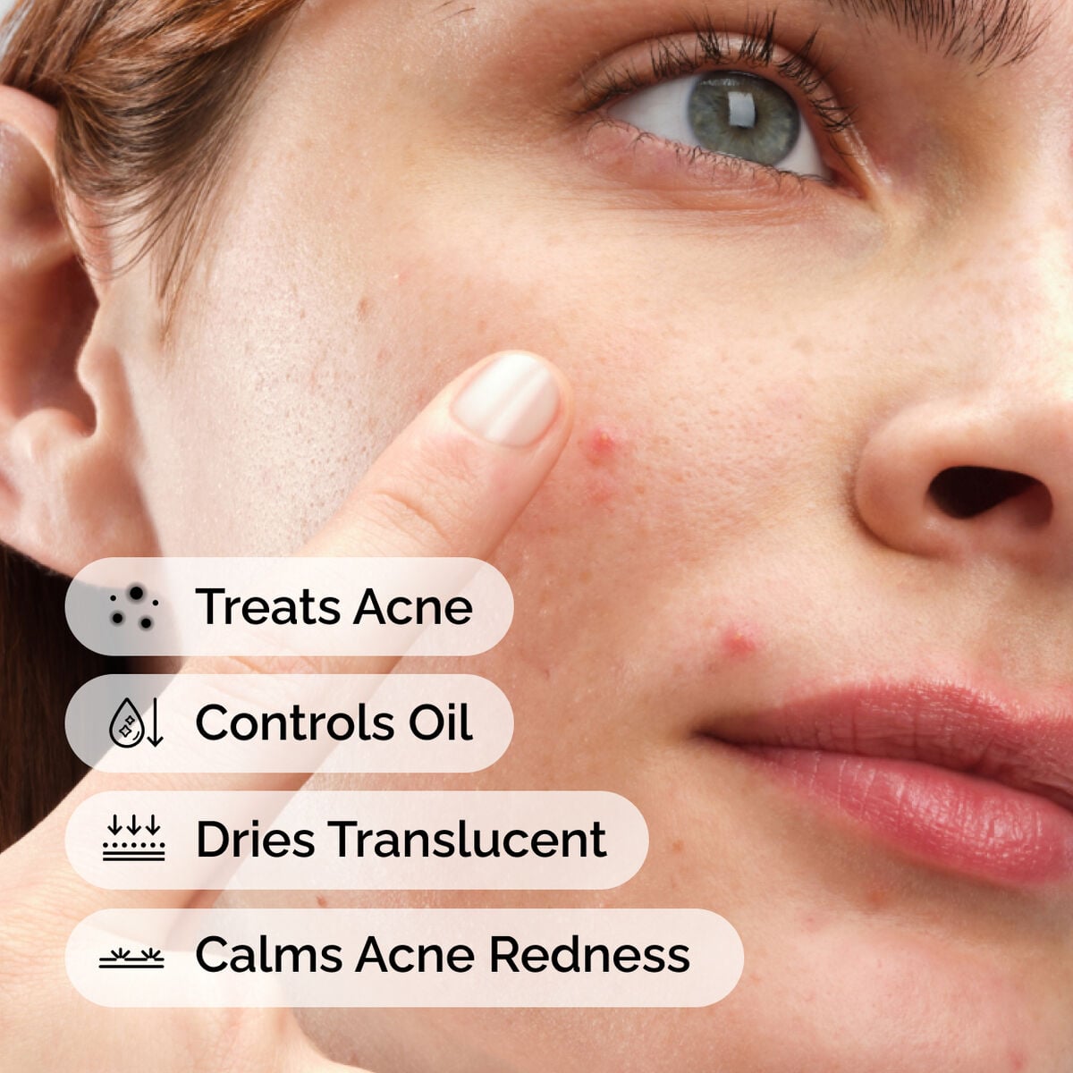 sulfur-10-powder-to-cream-concentrate-n2 ord-sulfur-10pct-powder-to-cream-concentrate-model-application-with-benefits-acne.jpg